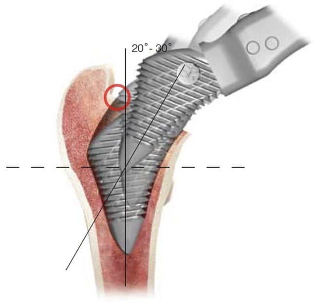 Diagram of broaching a short metaphyseal-filling stem with entry angled to pass under the overhanging greater trochanter