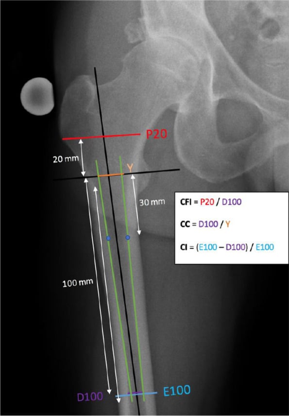 Preoperative hip radiograph with canal flare index, canal-to-calcar isthmus ratio and cortical index drawn from measured landmarks