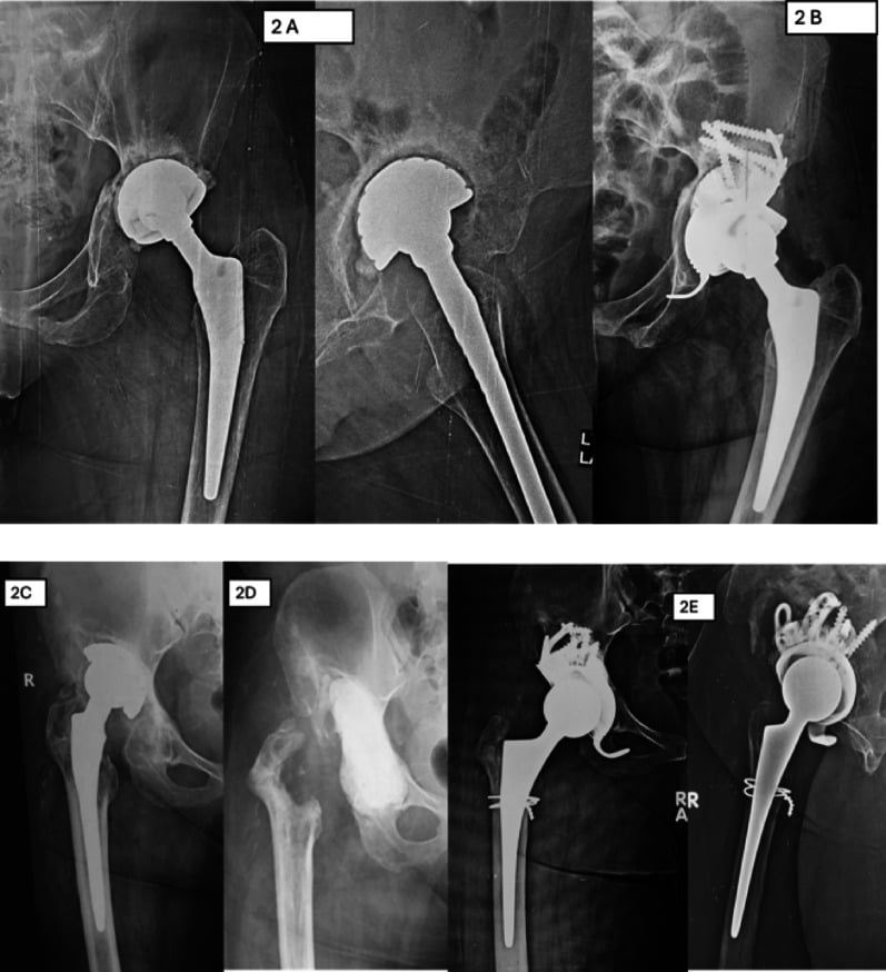 Radiographs of a failed hemiarthroplasty and a septically loose cementless acetabular cup with their revision reconstructions