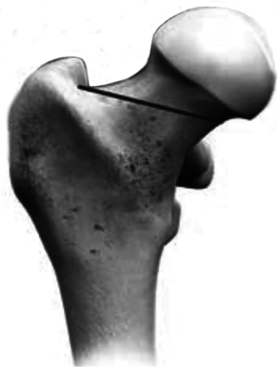Diagram of the proximal femoral neck cut perpendicular to the medullary axis from subcapital junction to greater trochanter