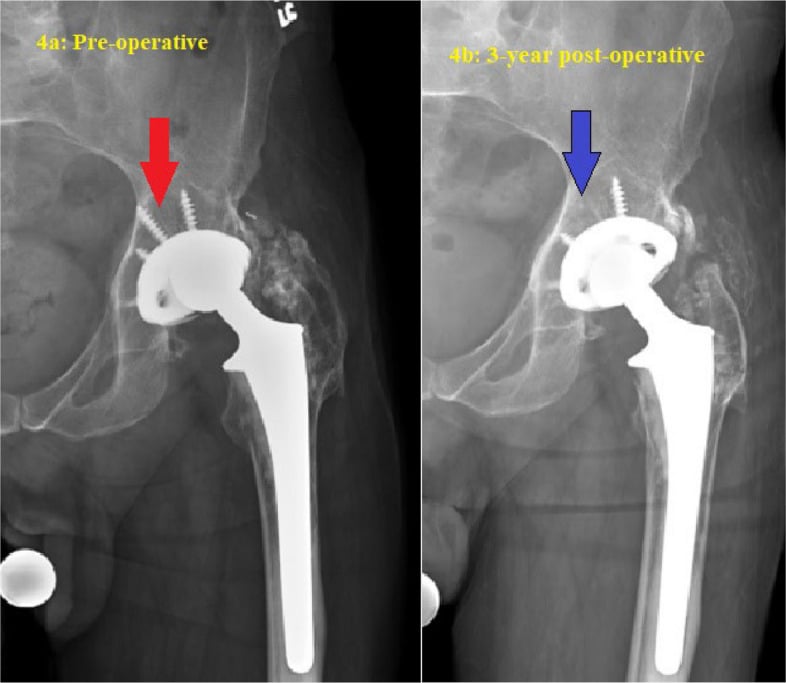 Serial radiographs of retro-acetabular osteolysis from polyethylene wear treated by isolated liner and head exchange with grafting