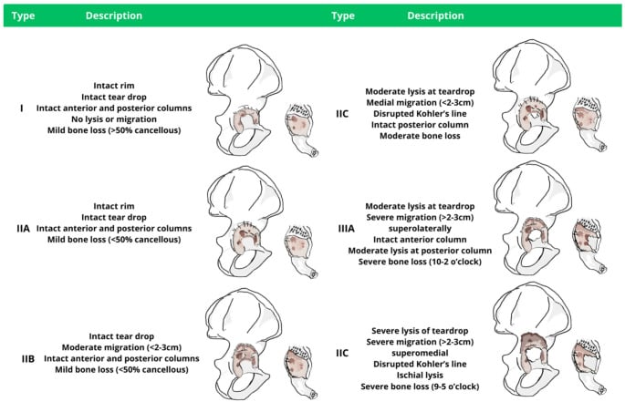 Schematic of the Paprosky acetabular classification from intact rim through severe migration and ischial lysis