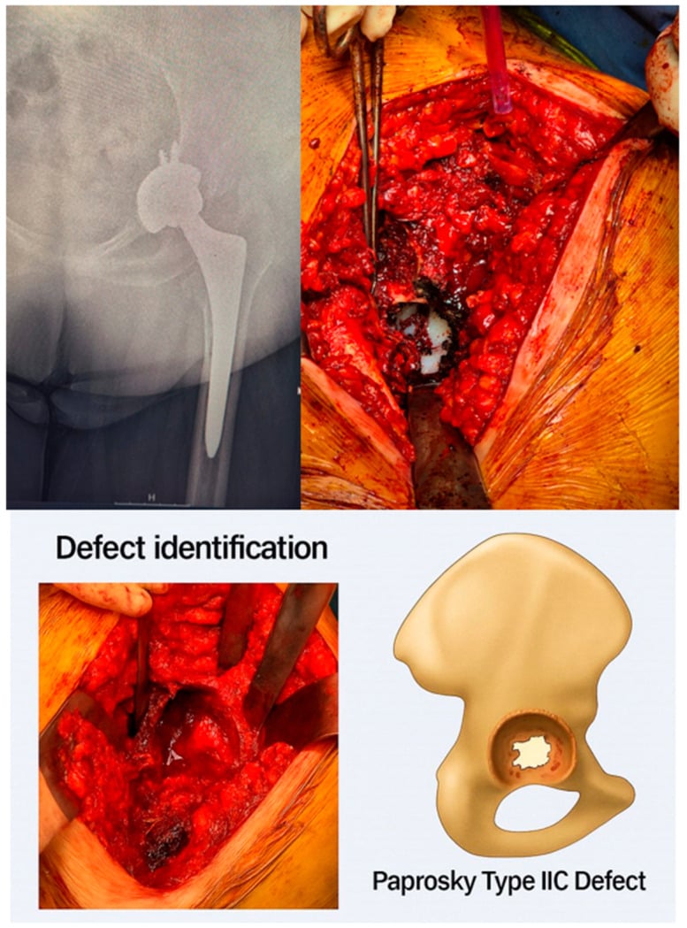 Radiographic and intraoperative views of a Paprosky type IIC acetabular defect with the defect identified against a schematic