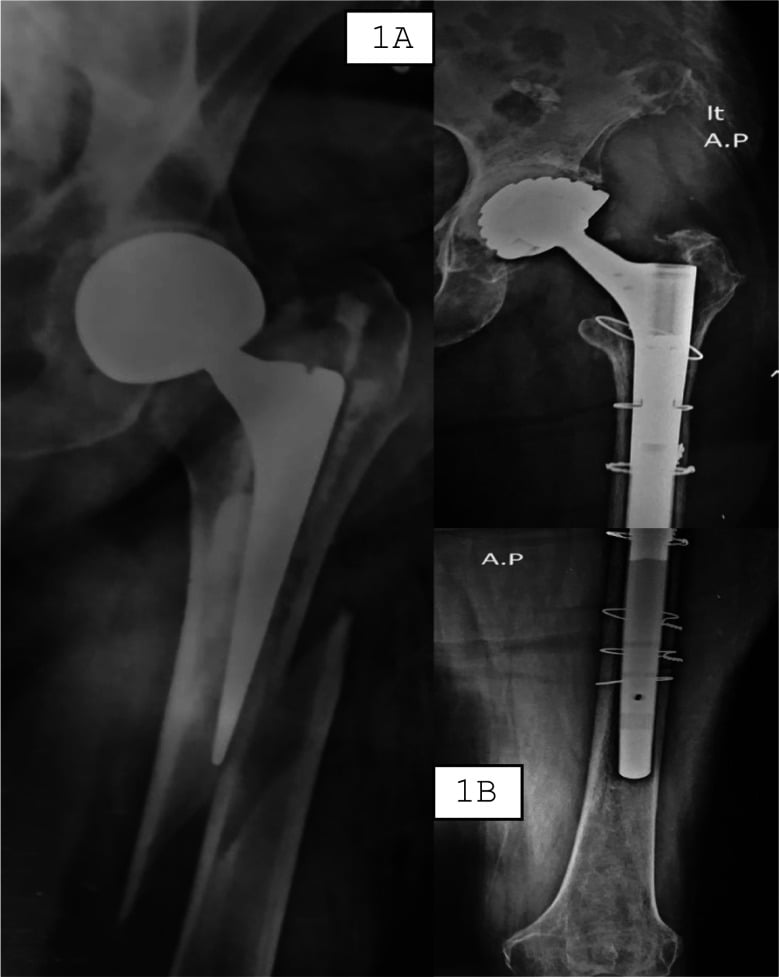 AP radiographs of a periprosthetic femoral fracture before and after revision with a modular cementless long stem