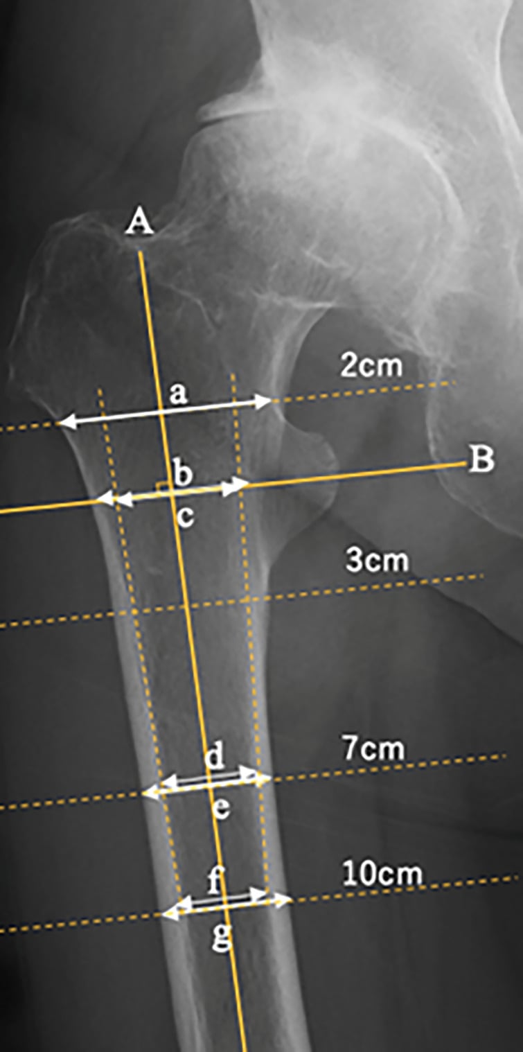 Radiograph annotated with canal-to-calcar ratio, canal diaphysis ratio, canal flare index, cortical thickness index and measurement levels at 2, 3, 7 and 10 cm