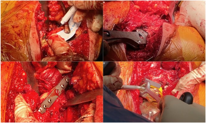 Intraoperative photographs of a transverse subtrochanteric shortening osteotomy with broaching and cemented stem insertion in dysplasia