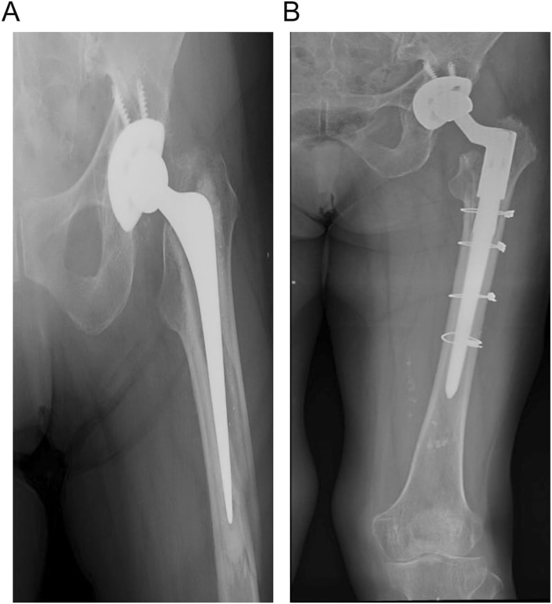 Radiographs of a Vancouver B2 periprosthetic fracture around a polished taper-slip stem revised to an uncemented fluted modular tapered stem