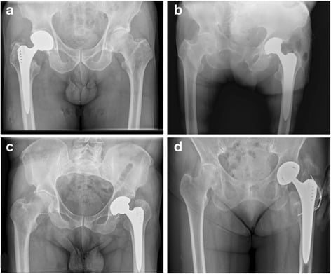 Four hip radiographs showing Brooker grades I to IV heterotopic ossification after total hip arthroplasty.