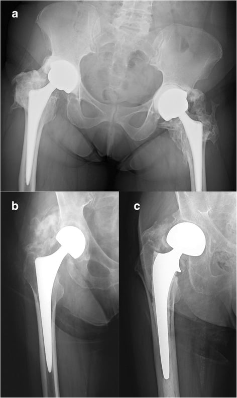 Radiographs showing high-grade heterotopic ossification around three different hip implant constructs.