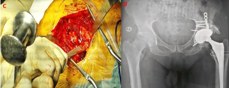 Operative release of a heterotopic bone bridge with an osteotome and postoperative hip radiograph after total hip arthroplasty.