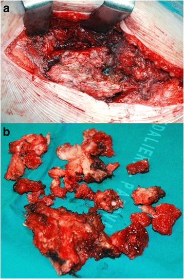 Operative field and excised heterotopic bone fragments from severe heterotopic ossification after total hip arthroplasty.