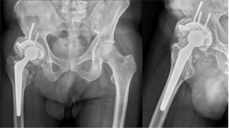 AP and lateral radiographs showing mature heterotopic ossification around a well-fixed total hip replacement at long-term follow-up.