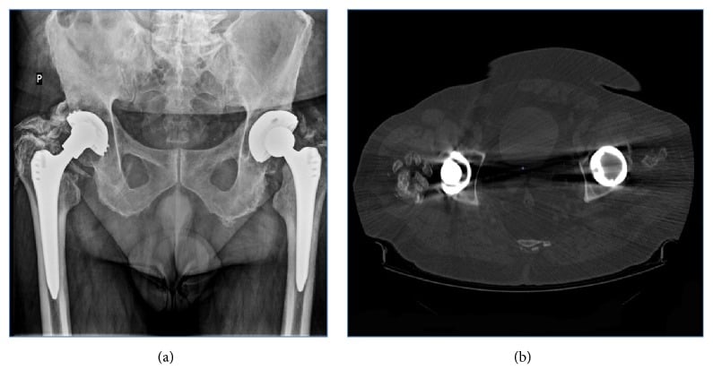 AP radiograph and CT scan showing complete hip ankylosis from severe heterotopic ossification around total hip replacements.