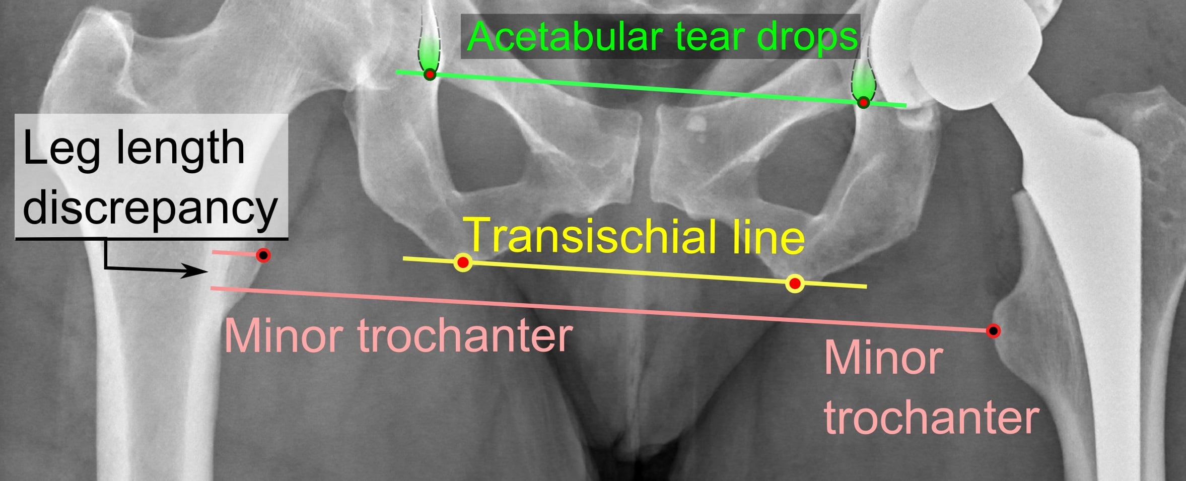 Annotated AP pelvic radiograph after hip replacement showing acetabular teardrops, a transischial line and bilateral lesser-trochanter landmarks used to measure radiographic leg-length discrepancy.