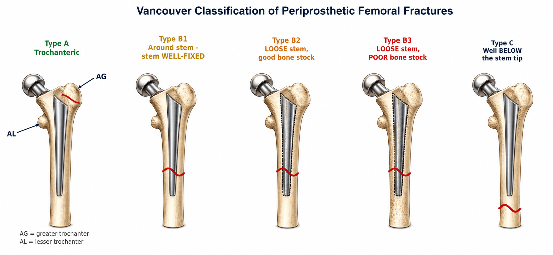 Vancouver classification of periprosthetic femoral fractures