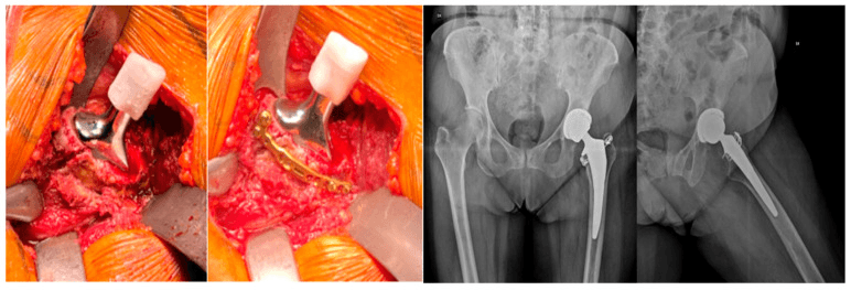 Operative photographs of an anterior cortical intraoperative fracture before and after plate fixation, with follow-up radiographs