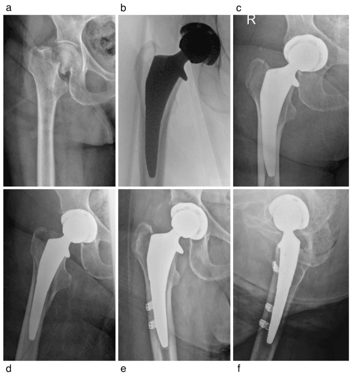 Serial radiographs (a-f) of a Vancouver B1 fracture after hemiarthroplasty treated with cerclage cables