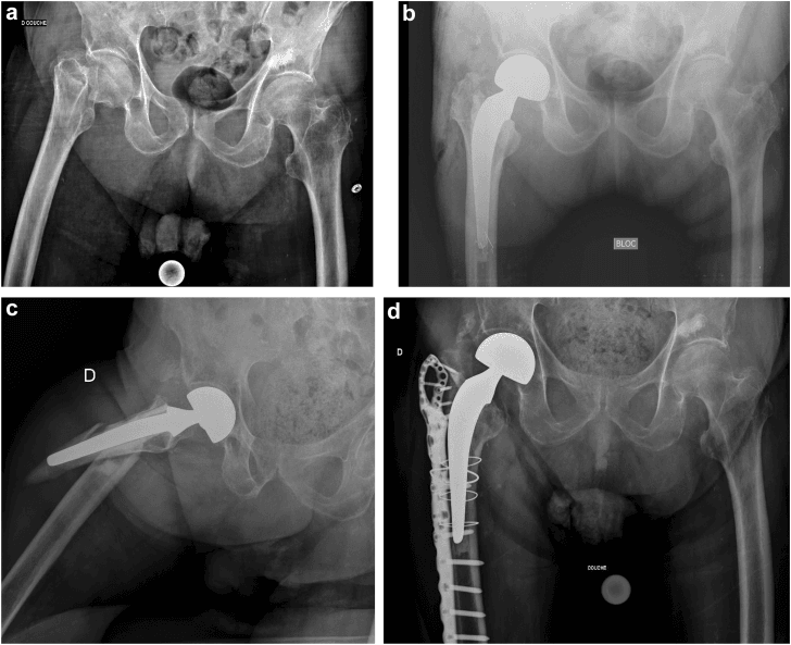 Serial radiographs (a-d): pelvis before arthroplasty, cemented stem, later Vancouver B1 fracture, and ORIF with a long plate, screws and cerclage
