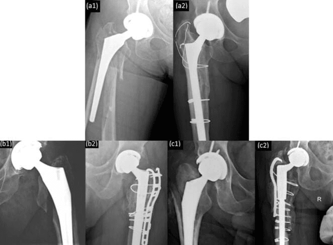 Three Vancouver B2/B3 cases before (a1, b1, c1) and after (a2, b2, c2) treatment, comparing fracture-first and stem-first revision strategies