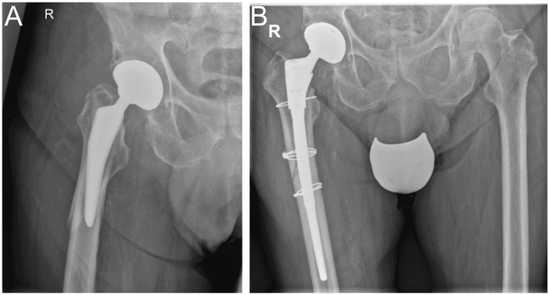 Early postoperative Vancouver B2 fracture after uncemented THA (A) and after revision to a long stem with cerclage (B)