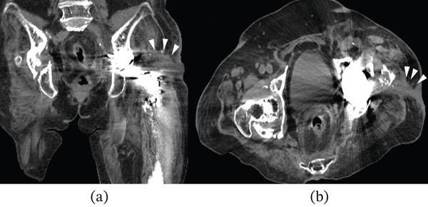 CT showing proximal femoral abscess and osteolysis around hip arthroplasty