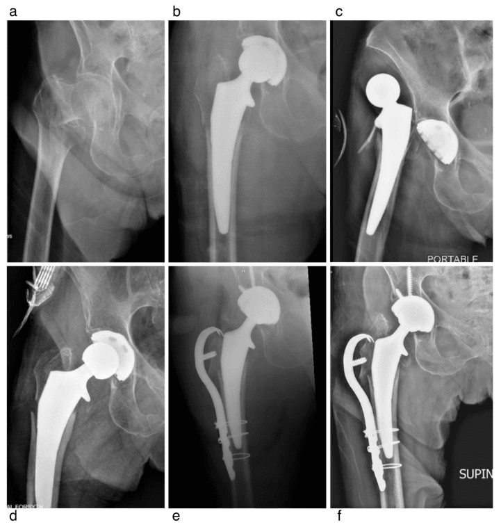 Serial radiographs (a-f) of an intraoperative Vancouver AG fracture, later dislocation (c), and trochanteric fixation