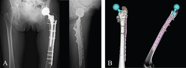 Postoperative radiographs (A) and three-dimensional CT reconstructions (B) of plate and screw fixation around a hip stem