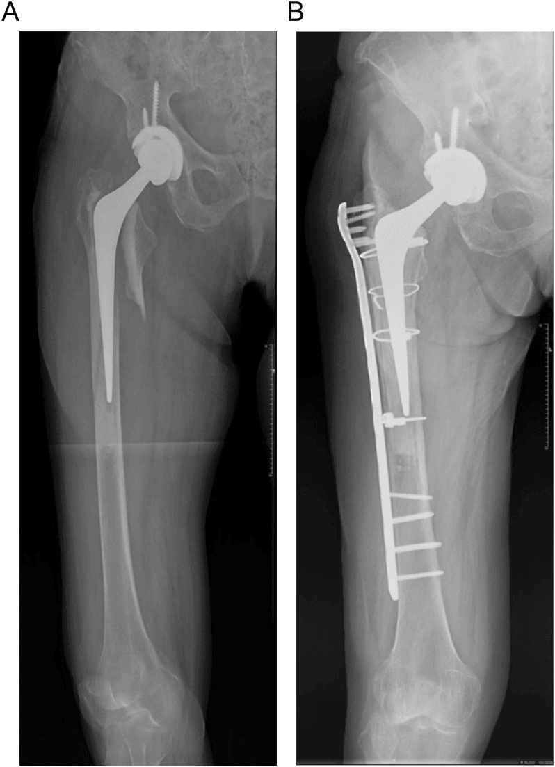 Vancouver B2 fracture around a polished taper-slip stem (A) and after plate and cerclage ORIF (B)