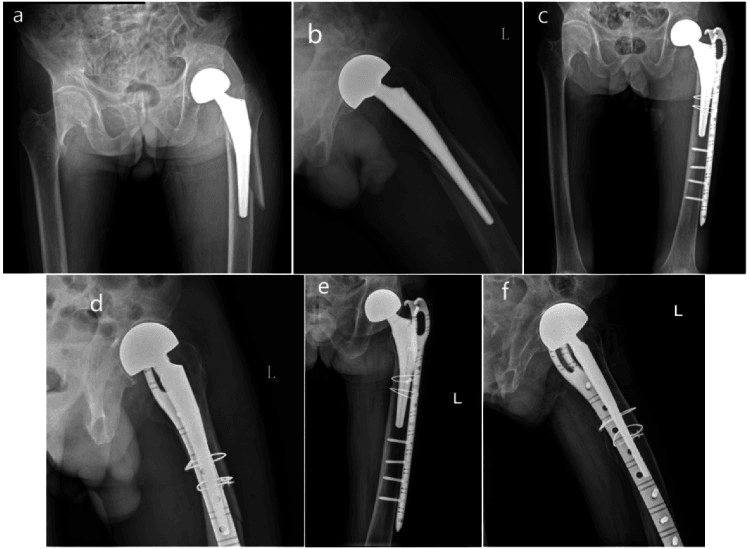 Serial radiographs of selected Vancouver B2 fracture treated with ORIF
