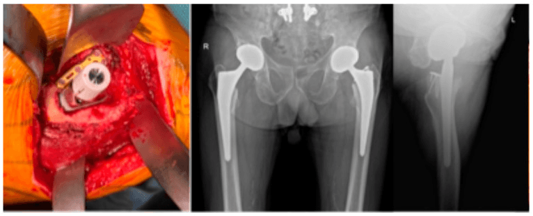 Operative photograph of a short plate with locking screws at the base of the greater trochanter, with follow-up radiographs
