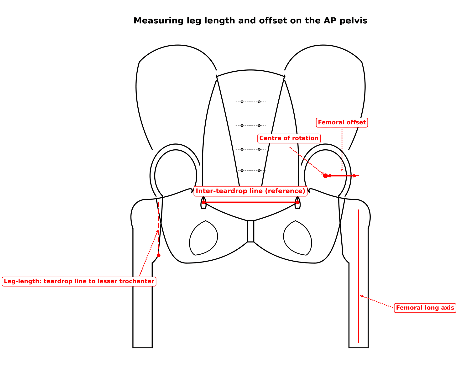 AP pelvis line diagram showing the inter-teardrop line, leg-length measurement to the lesser trochanter, centre of rotation, femoral long axis and femoral offset