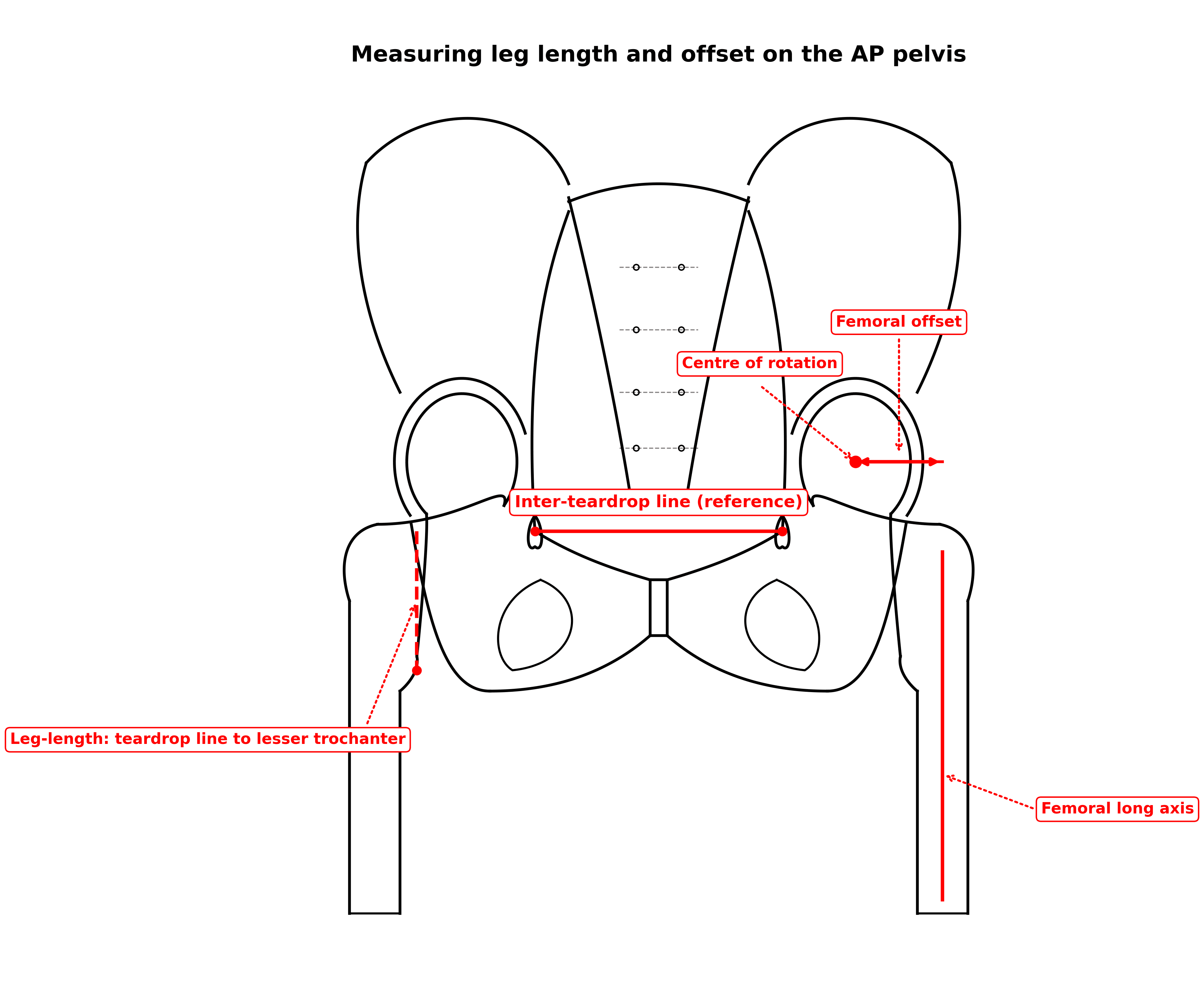 AP pelvis line diagram showing the inter-teardrop line, leg-length measurement to the lesser trochanter, centre of rotation, femoral long axis and femoral offset