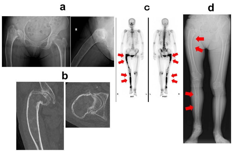 Radiographs, CT, bone scintigraphy and full-length imaging of a severely bowed femur with fibrous dysplasia