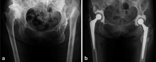 Preoperative and postoperative radiographs of complex dysplastic hips treated with total hip arthroplasty