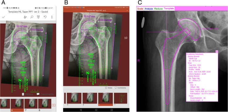 Femoral stem templates scaled and positioned on smartphone, tablet and conventional digital templating software