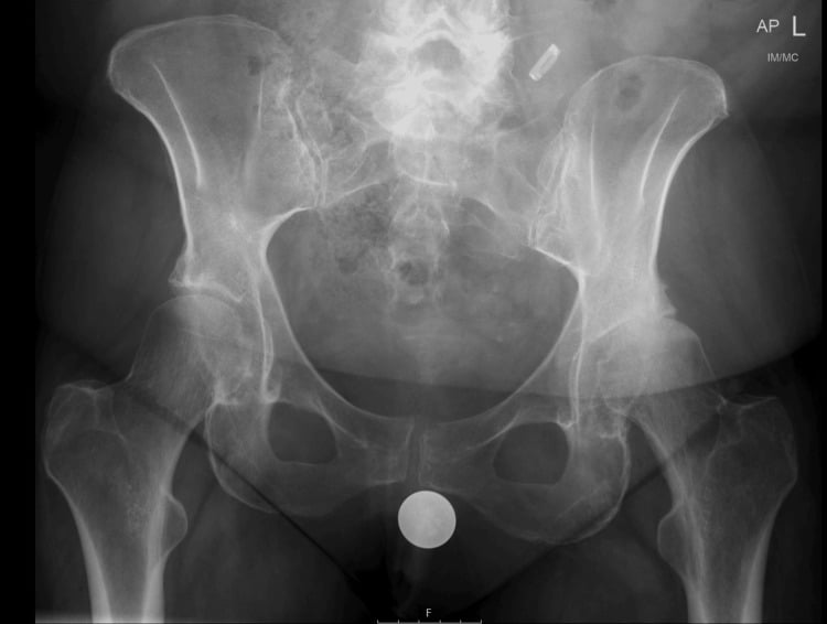 AP pelvis radiograph with a single spherical calibration marker projected between the upper thighs