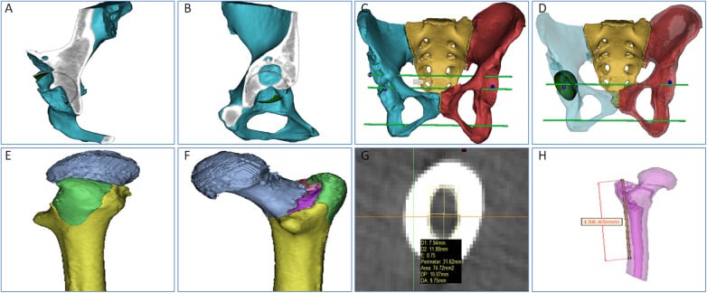 CT and three-dimensional models used to plan acetabular bone stock, hip centre, cup position and femoral reconstruction