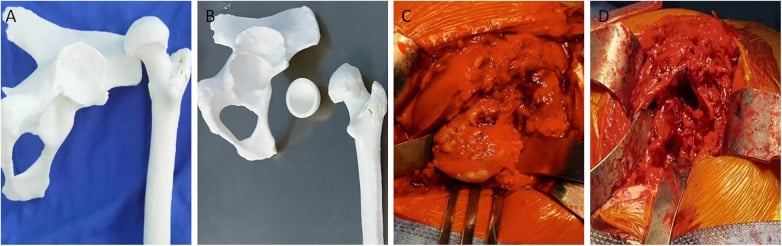 Physical patient-specific three-dimensional models of the pelvis and femur paired with operative views of the deformed hip