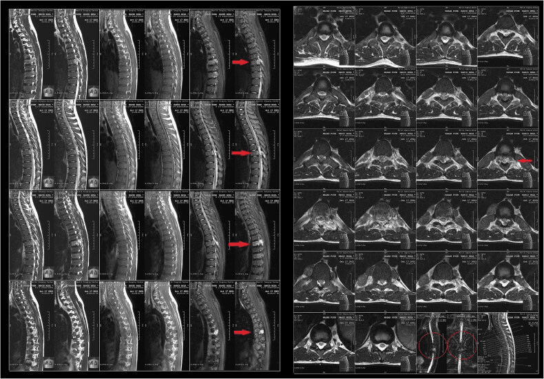 Sagittal and axial thoracic MRI series with red arrows and circles marking extramedullary-haematopoiesis tissue in the spinal canal
