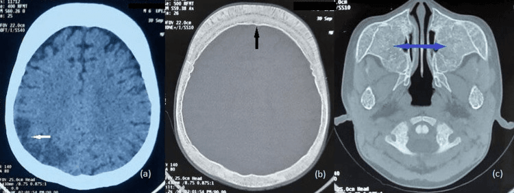 Three axial CT panels in beta-thalassaemia: a brain window (a), a bone window with widened frontal diploic space (b), and maxillary sinuses without pneumatisation (c)