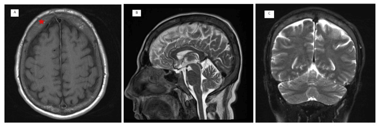 Axial sagittal and coronal cranial MRI showing frontal-predominant diploic-space expansion