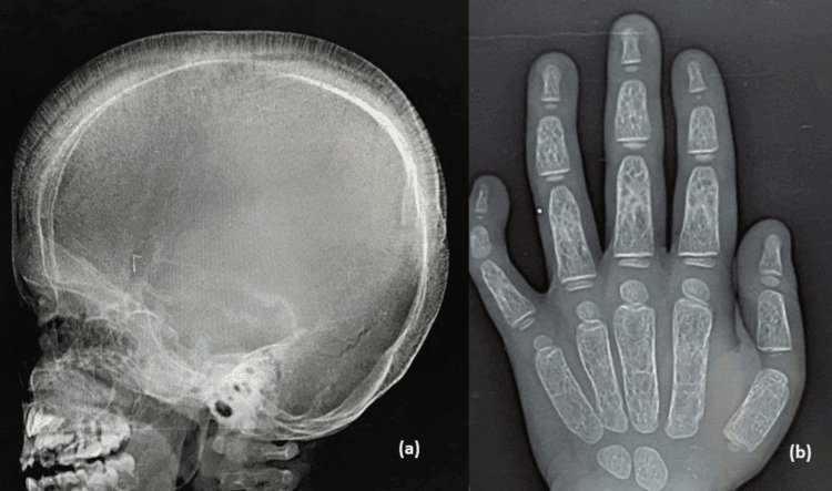 Lateral skull radiograph (a) and hand radiograph (b) showing hair-on-end calvarium and marrow-expansion changes in beta-thalassaemia