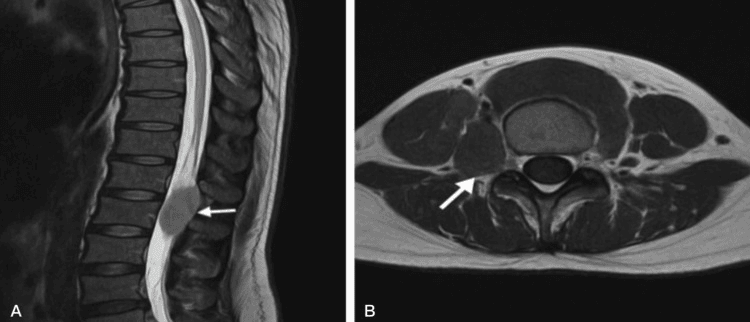 Sagittal T2-weighted (A) and axial (B) spinal MRI with arrows marking a paraspinal extramedullary-haematopoiesis mass