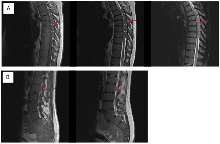 Multisequence sagittal thoracic (A) and lumbar (B) MRI with red arrows marking extramedullary haematopoiesis in the spinal canal