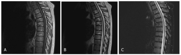 Follow-up sagittal thoracic MRI in three sequences (A-C) after radiotherapy for compressive extramedullary haematopoiesis