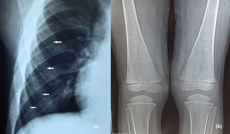 Chest radiograph (a) with arrows on rib-within-rib and knee radiographs (b) showing Erlenmeyer-flask deformities in beta-thalassaemia