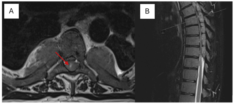 Axial (A) and sagittal (B) thoracic MRI showing extramedullary-haematopoiesis tissue flanking the vertebral body and compromising the spinal canal