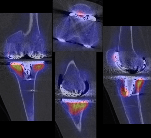 SPECT/CT of a total knee replacement with intense tracer uptake under the tibial tray, indicating mechanical loosening.