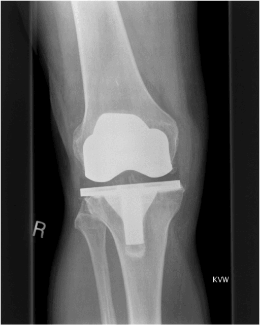 Knee radiograph after total knee replacement with arrow marking a medial femoral osteophyte and tibial component overhanging the bone.