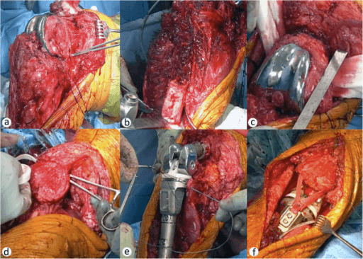 Intraoperative photograph of a knee exposed through a medial parapatellar approach with the patellar ligament divided.